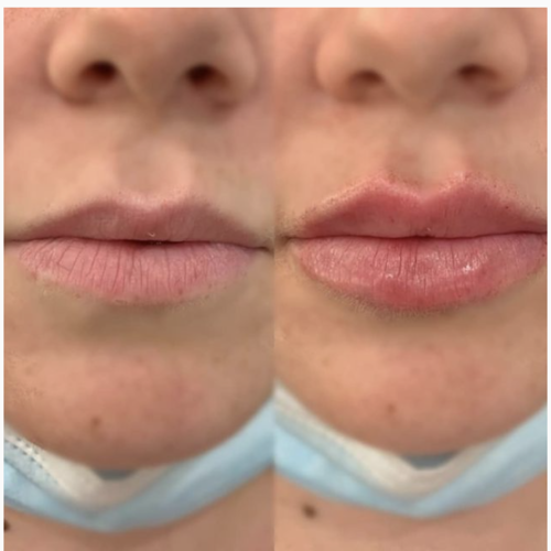 Fillers Before & After Treatment result in Pasadena, CA | SkinFX Medical Spa
