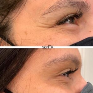 BOTOX Pasadena CA | Results 3