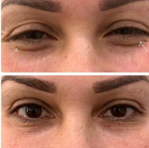 BOTOX Pasadena CA | Results 4