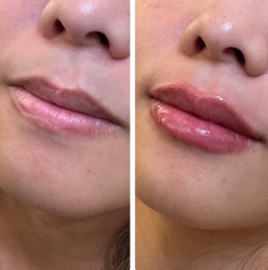 Lip Filler Pasadena - SkinFX Medical Spa plumped lips