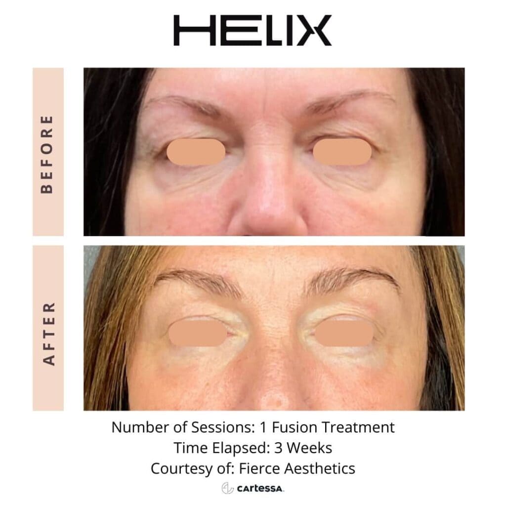 Laser Skin Resurfacing 1 HELIX Skinfx Medical Spa Treatment