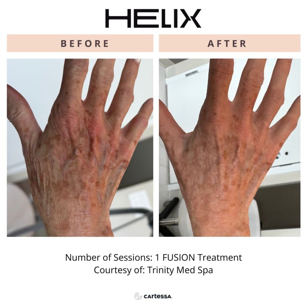 Laser Skin Resurfacing 8 Hands Transfusion