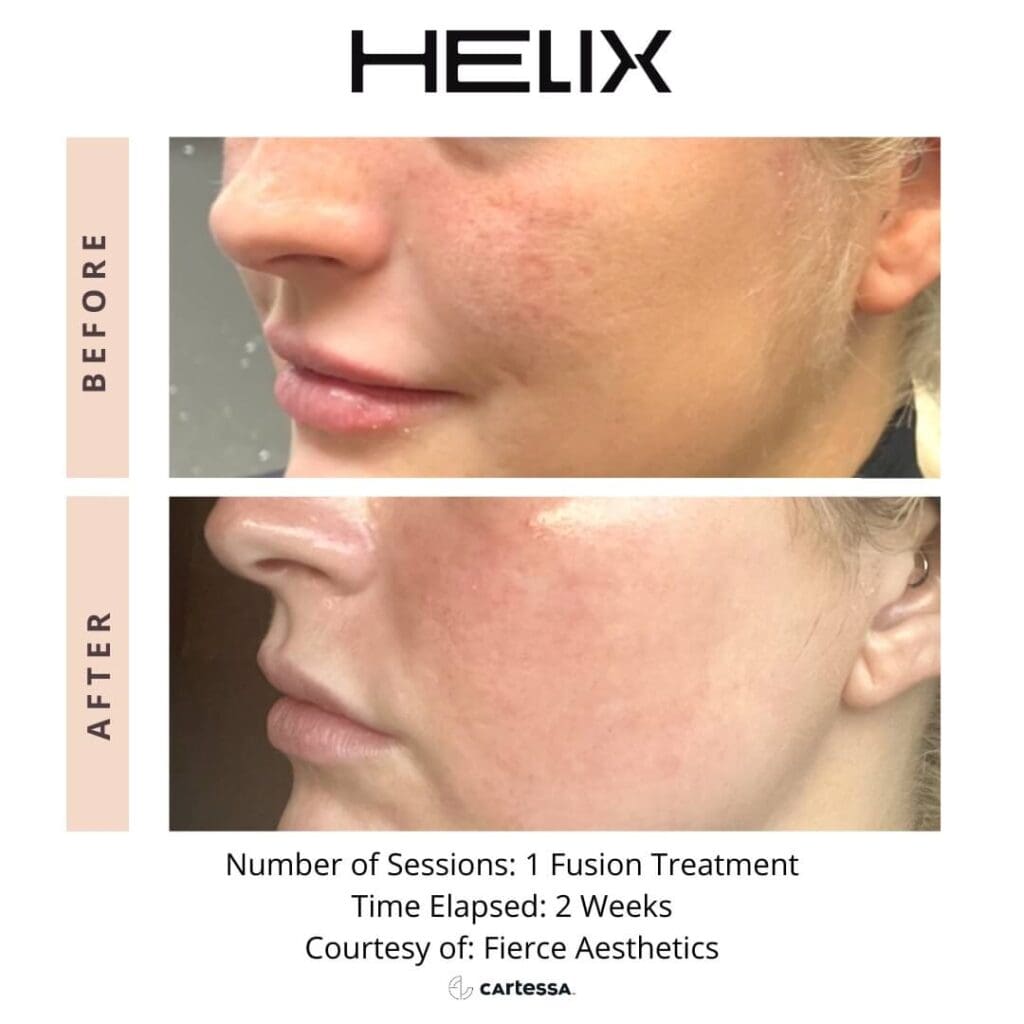 Laser Skin Resurfacing 2 face fusion