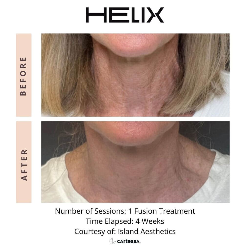 Laser Skin Resurfacing 5 neck fusion