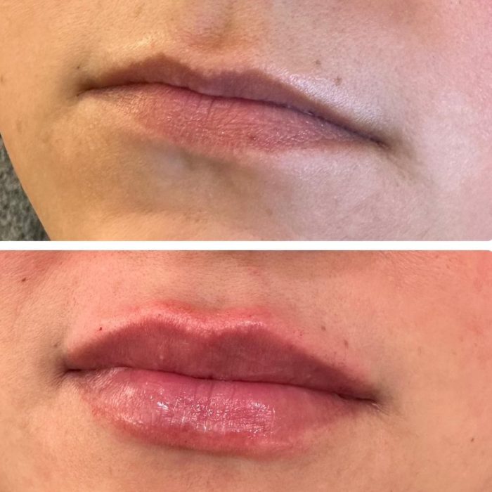 Lip Filler Pasadena - SkinFX Medical Spa